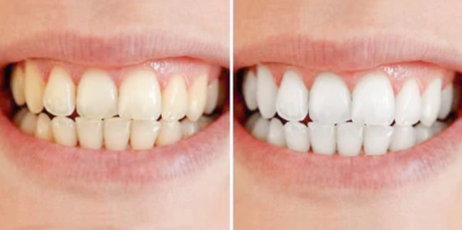 Teeth whitening pen – Clinically inspired whitening at home