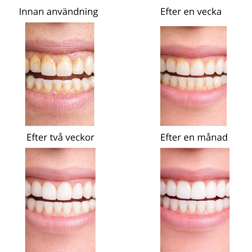 GlowSmile™ – Ultrasonic cleaning