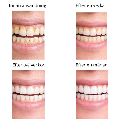 GlowSmile™ – Ultrasonic cleaning