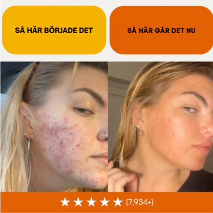 Acne Killer Kit - Effective against Pimples, Redness and Pores