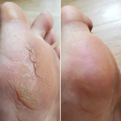 Bliss Silk Pro 2 – Soft feet without expensive salon visits