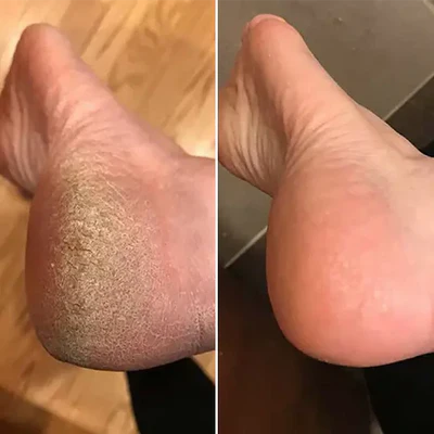 Bliss Silk Pro 2 – Soft feet without expensive salon visits