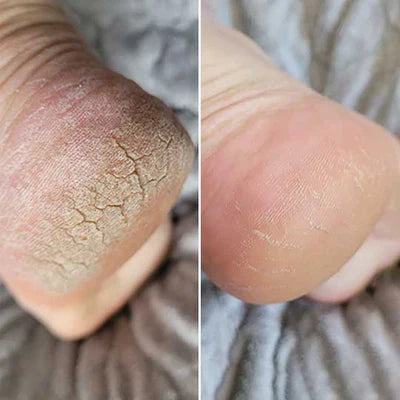 Bliss Silk Pro 2 – Soft feet without expensive salon visits
